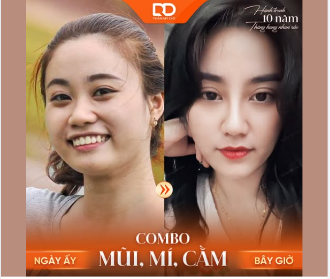 KHÁCH HÀNG "BIẾN HÌNH" SAU KHI THỰC HIỆN COMBO NÂNG MŨI + CẮT MÍ + ĐỘN CẰM TẠI DRD