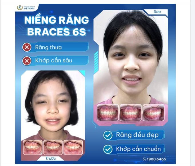 LÊ HÀ AN – HÀNH TRÌNH TỪ “CÔ BÉ RĂNG THƯA” ĐẾN NỤ CƯỜI TỰ TIN TỎA SÁNG!
