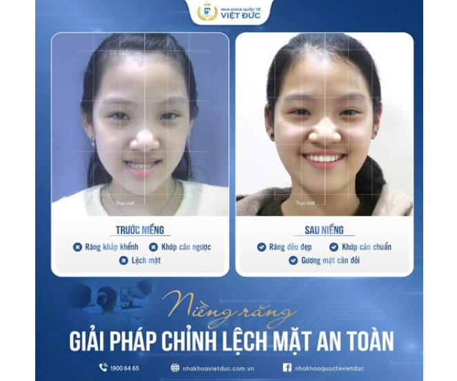 LÝ DO NÊN CAN THIỆP NIỀNG RĂNG SỚM CHO TRẺ
