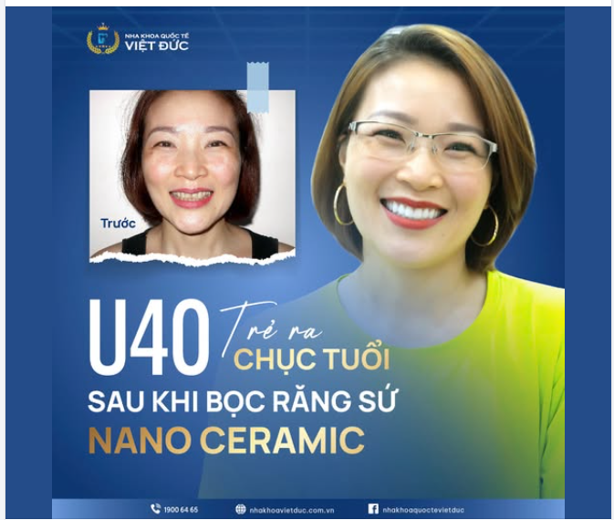 TRỊNH THỊ YẾN – TRẺ ĐẸP NGOẠN MỤC SAU KHI BỌC RĂNG SỨ NANO CERAMIC
