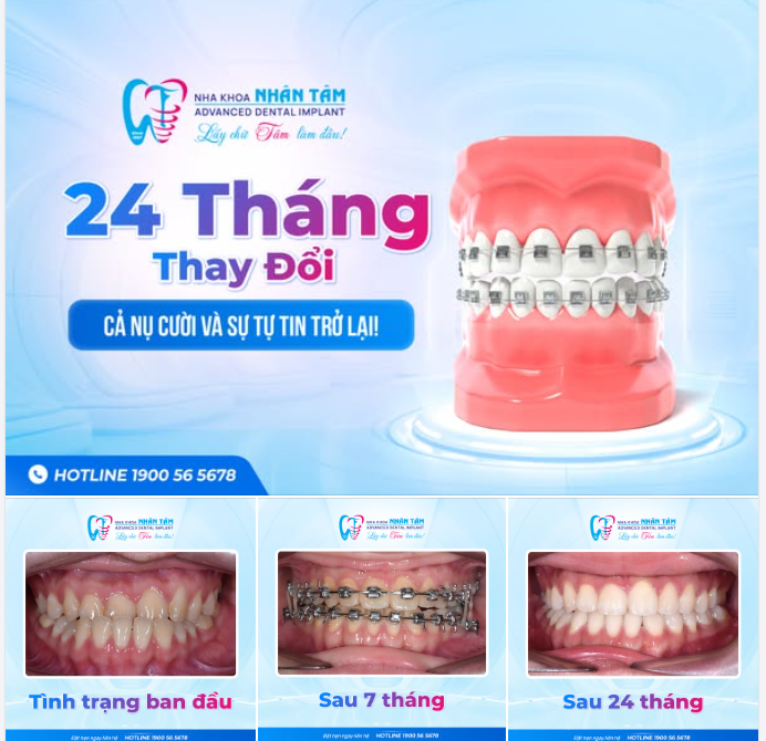 24 THÁNG THAY ĐỔI - CẢ NỤ CƯỜI VÀ SỰ TỰ TIN TRỞ LẠI