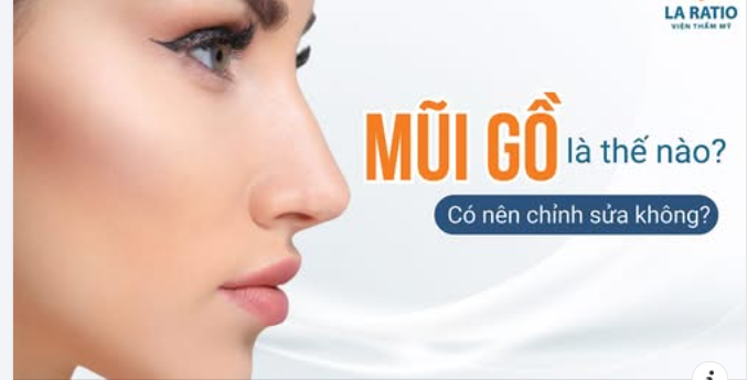 Mũi gồ tuy không phải là vấn đề có thể ảnh hưởng đến sức khoẻ, nhưng lại là “điểm trừ” lớn khiến gương mặt mất cân đối