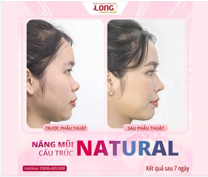 Rất nhiều chị em ngần ngại làm đẹp chỉ vì sợ mất đi nét riêng, sợ sau nâng mũi thì gương mặt không còn là chính mình nữa.