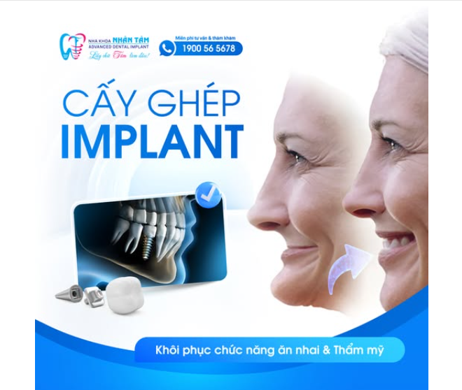 CẤY GHÉP IMPLANT: KHÔI PHỤC CHỨC NĂNG ĂN NHAI VÀ THẨM MỸ