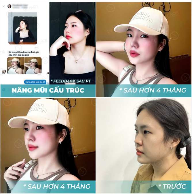 FEEDBACK ngọt lịm sau 4 tháng “NHÌN MŨI ĐÃ QUÁ BÁC ƠI!”