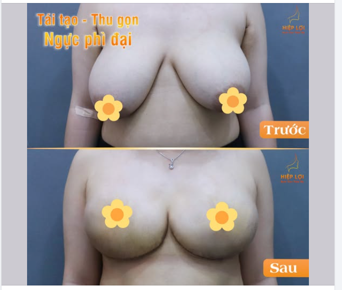 TÁI TẠO - THU GỌN NGỰC PHÌ ĐẠI – LẤY LẠI VẺ ĐẸP TỰ NHIÊN !