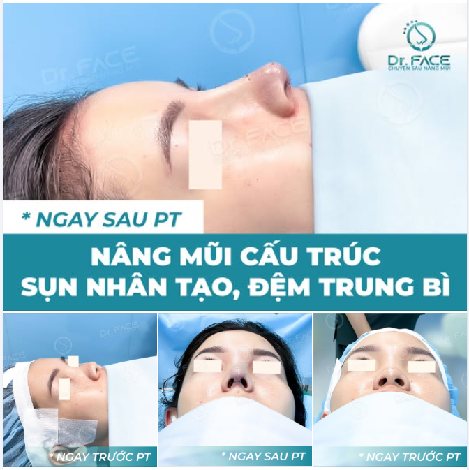 Ngay sau PT, mũi đã cao thanh thoát, đầu mũi nhẹ nhàng và sắc nét – không cần lớp make up nào cũng đủ tự tin ​​​​​​​.