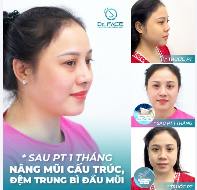 Dáng mũi CÁ NHÂN HOÁ – Đẹp tự nhiên, KHÔNG HỀ ĐẠI TRÀ