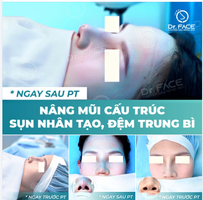 HỆ QUẢ CỦA SILICONE CÓ CHÂN LÀ NHƯ NÀY NÈ…