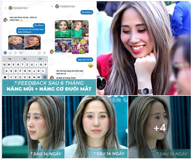 Mũi GỒ GHỀ, GÃY KHÚC – Giờ đã “VÀO FORM”, ai cũng khen