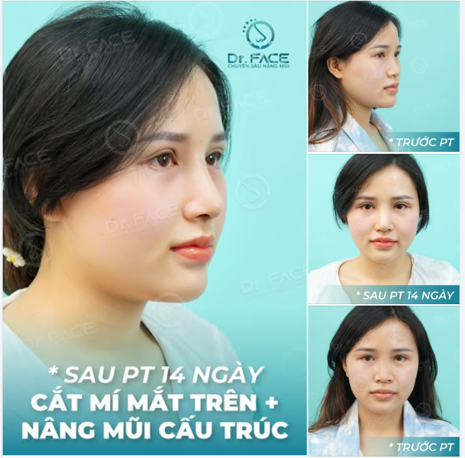 À, lúc này là được 14 ngày, mí cần nhiều thời gian hơn để gom gọn và đều nhau nhé cả nhà, nhưng mà nhìn kết quả này là đã biết chắc chắn sẽ rất tự nhiên rồi ha!