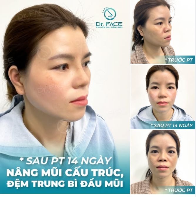 3 LẦN SỬA – 3 LẦN THẤT VỌNG, LẦN THỨ 4 MỚI THẬT SỰ MỈM CƯỜI