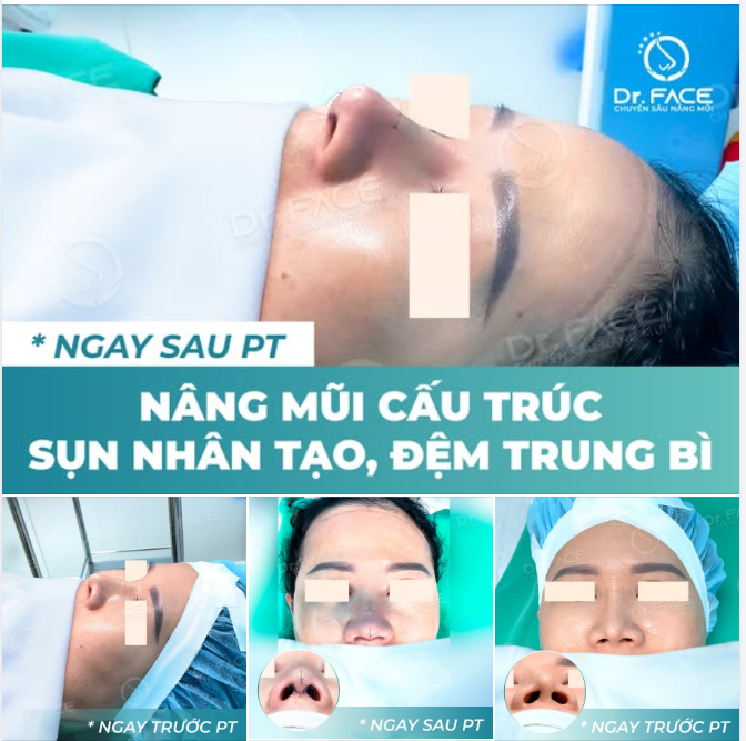 “ĐẦU MŨI em bị NHỌN TRẮNG thấy rõ luôn BS ơi…”