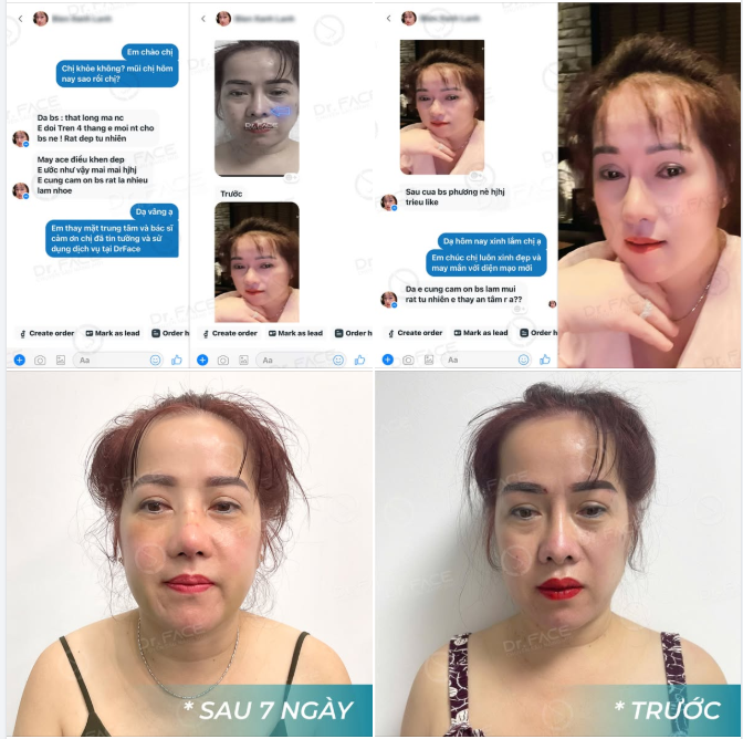 “TÁI SINH” CHIẾC MŨI SAU 3 LẦN THẤT VỌNG