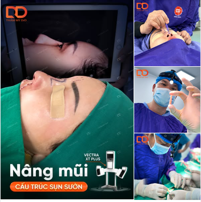 ƯU ĐIỂM CỦA NÂNG MŨI CẤU TRÚC SỤN SƯỜN???