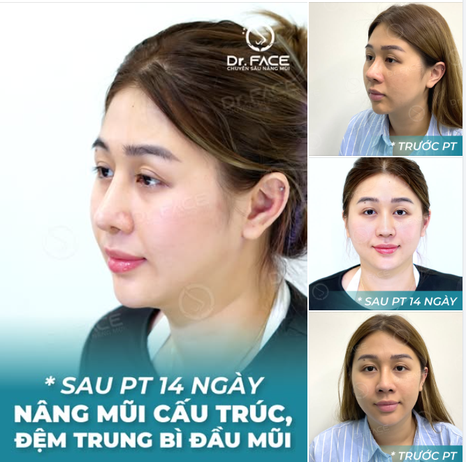 MŨI VỪA NHỌN THÔ VỪA LỆCH – PHẢI LÀM SAO?