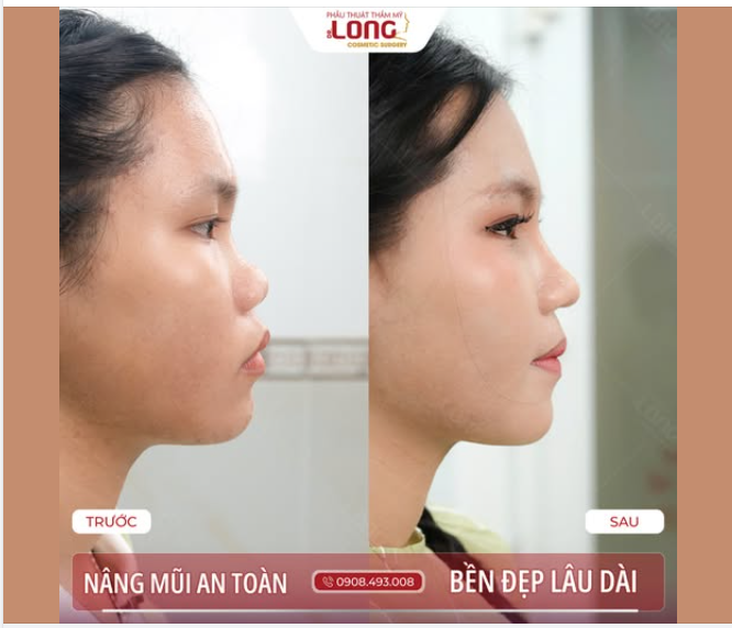 SỨC MẠNH CỦA 1 CHIẾC MŨI ĐẸP