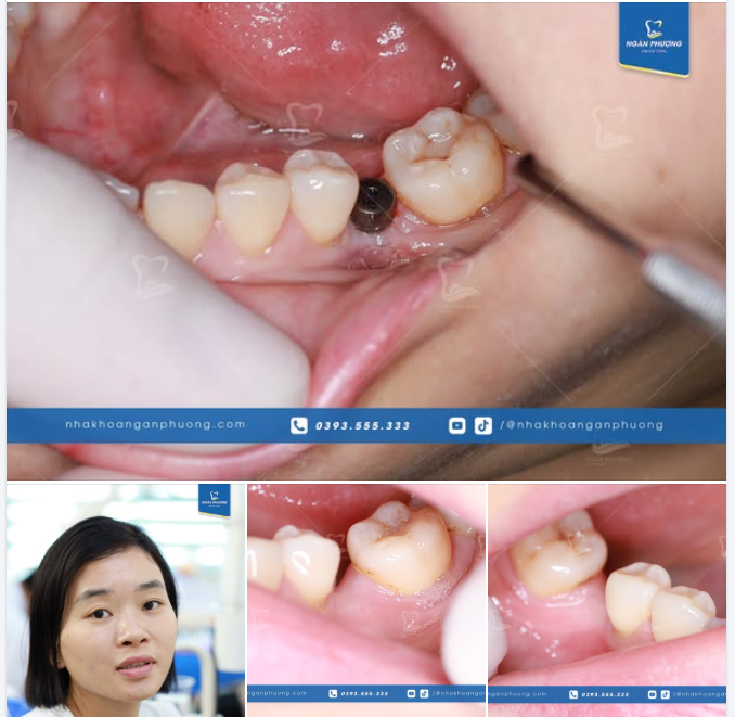 Phục hình implant răng 6 với khoảng siêu hẹp