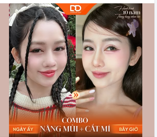 COMBO NÂNG MŨI + CẮT MÍ - NÂNG TẦM NHAN SẮC 1 CÁCH "NGOẠN MỤC"