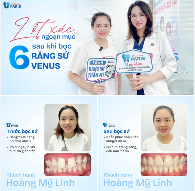 Lột xác ngoạn mục sau khi bọc 6 răng sứ Venus