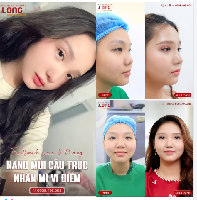 Khách nhà em khoe diện mạo mới sau 8 tháng nâng mũi, nhấn mí