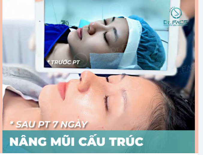 MŨI 7 NGÀY – ĐẸP TỚI CỠ NÀO?