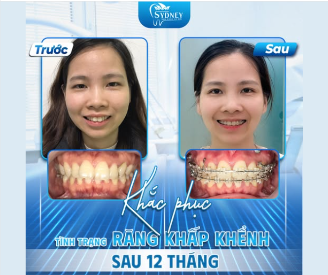 KHẮC PHỤC TÌNH TRẠNG RĂNG KHẤP KHỂNH SAU 12 THÁNG