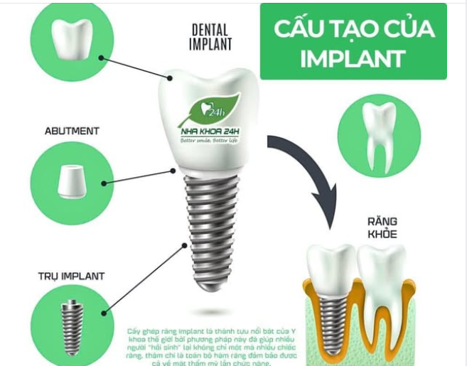 Vậy bạn đã biết răng Implant được cấu tạo như thế nào chưa?