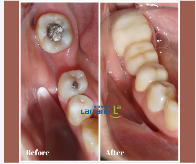 Răng khôn ở trong cùng, đôi khi cũng rất hữu ích khi làm cầu răng để phục hình răng bị mất ạ
