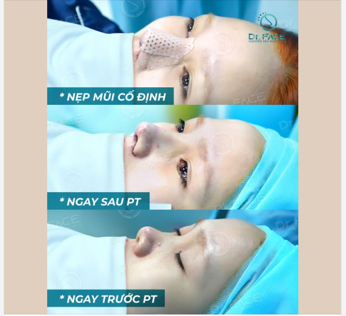 NẸP MŨI ĐỂ LÀM GÌ?