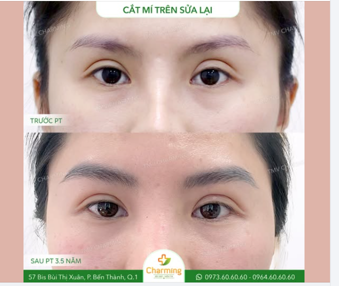 Một ca sửa mí thành công là khi không ai nhận ra từng sửa – và nàng chính là minh chứng cho điều đó.