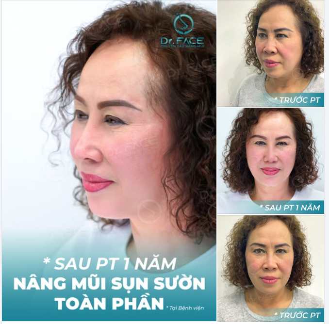 MŨI SAU 1 NĂM CÀNG ĐẸP QUÁ CHỊ ƠI!