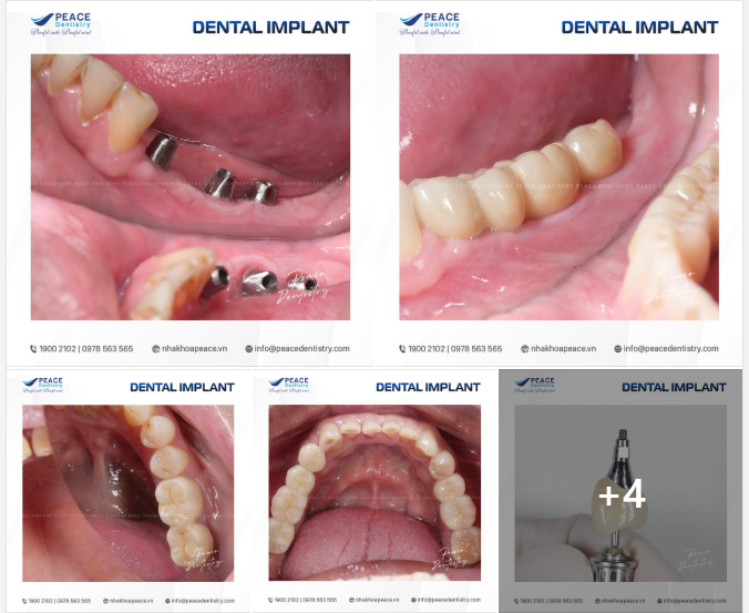 Xem ngay kết quả ấn tượng sau hoàn tất phục hình trên 3 đơn vị Implant tại Peace Dentistry!