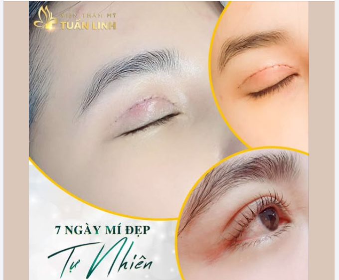 7 NGÀY - Sở hữu nếp mí đẹp tự nhiên, đôi mắt to tròn cuốn hút.