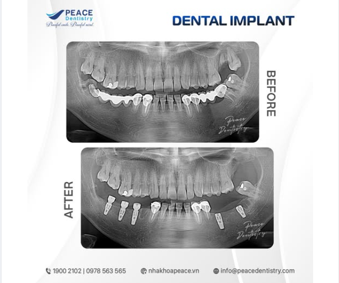 Thay cầu răng sứ bằng Implant → khôi phục trọn vẹn sức nhai & thẩm mỹ nụ cười
