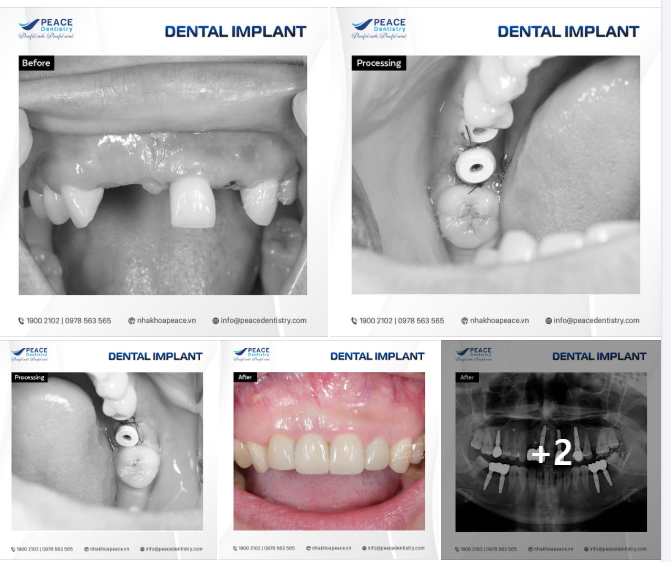 CA LÂM SÀNG IMPLANT VÙNG RĂNG CỬA CÓ CHỈ ĐỊNH GHÉP XƯƠNG, GHÉP NƯỚU