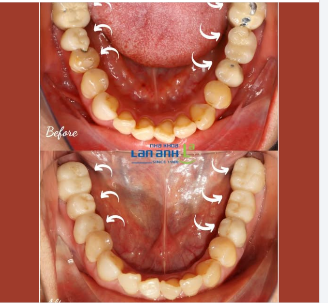 Răng sứ làm ở nơi khác, theo kỹ thuật cũ – sau một thời gian sử dụng thì bị mẻ, để lộ cả khung sườn…