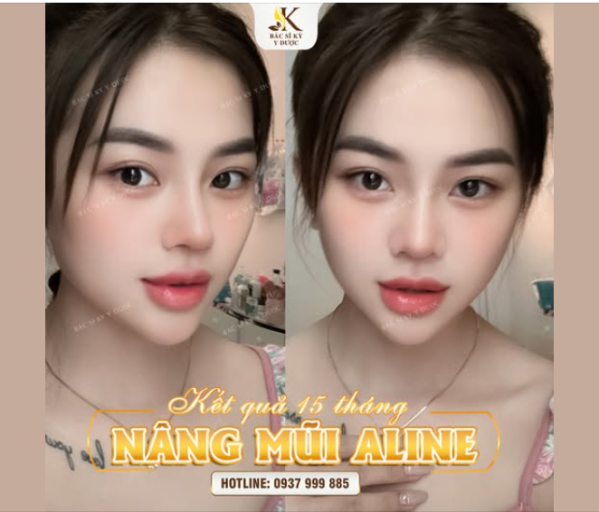 FEEDBACK KH NÂNG MŨI ALINE tại NHA TRANG
