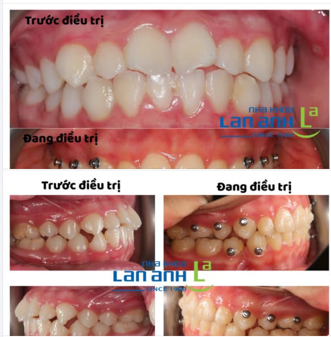 Niềng răng giảm hô bằng khay trong suốt tại nha khoa Lan Anh nhẹ nhàng, đơn giản và hiệu quả