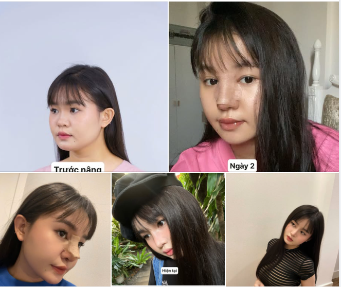 Như Ý bật mí: “Sau nâng mũi là em không còn cần chỉnh ảnh nữa, vì góc nào cũng xinh!”