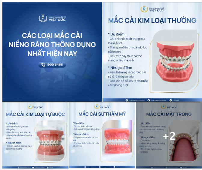 ƯU NHƯỢC ĐIỂM CỦA CÁC LOẠI MẮC CÀI NIỀNG RĂNG – NIỀNG RĂNG LOẠI NÀO TỐT?