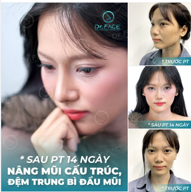 Bạn trai thì mê dáng mũi mới, ngày nào cũng đòi chụp hình để ngắm.