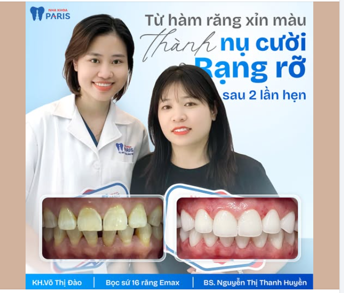Sau khi được bác sĩ Thanh Huyền thăm khám và tư vấn, chị lựa chọn bọc sứ 16 răng bằng dòng Emax – nhập khẩu từ Đức, nổi tiếng với 3 ưu điểm vượt trội: