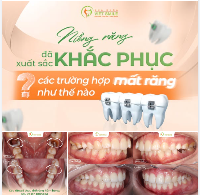NIỀNG RĂNG ĐÃ XUẤT SẮC KHẮC PHỤC TÌNH TRẠNG MẤT RĂNG NHƯ THẾ NÀO?