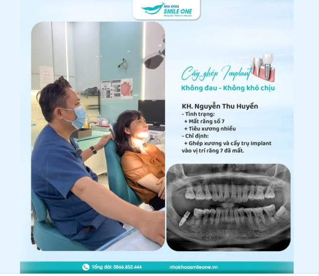 Cấy ghép Implant tại Nha khoa Smile One - Không đau, không khó chịu và tận hưởng sự tận tâm từ đội ngũ Bác sĩ.