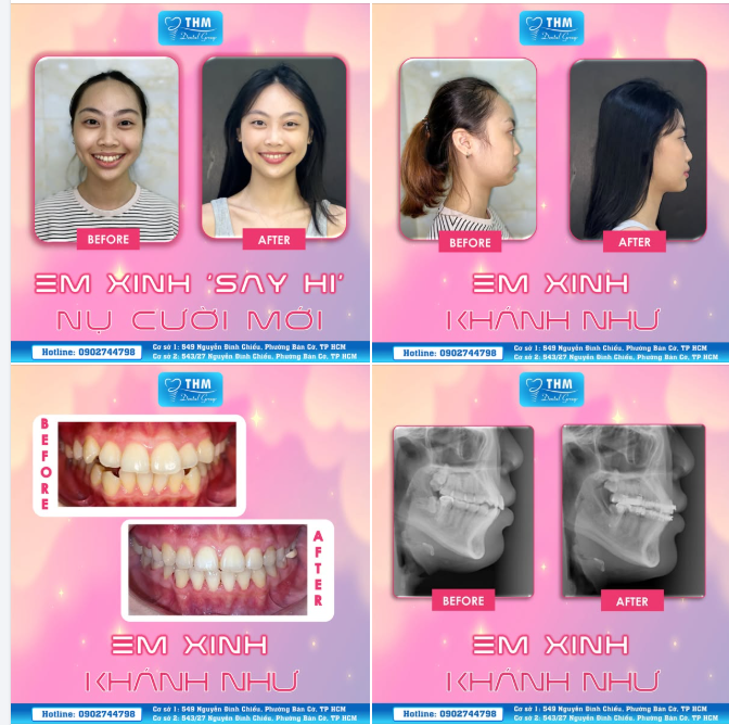 KHÁNH NHƯ VÀ HÀNH TRÌNH “LỘT XÁC” SAU 2,5 NĂM NIỀNG RĂNG