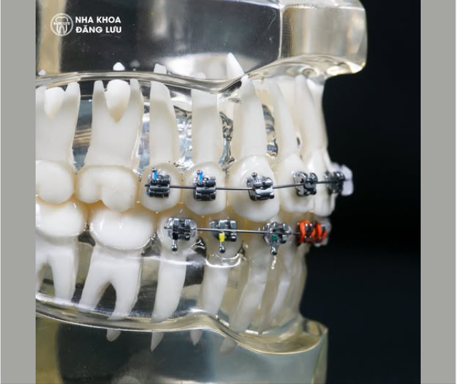 Ưu Đãi Combo "MÙA NIỀNG MƠ ƯỚC" Chỉ Có Tại Nha Khoa Đăng Lưu Dịp Hè Này:
