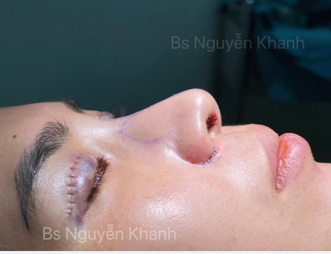 SẸO SAU PHẪU THUẬT – CÓ ĐÁNG LO NHƯ MỌI NGƯỜI NGHĨ?