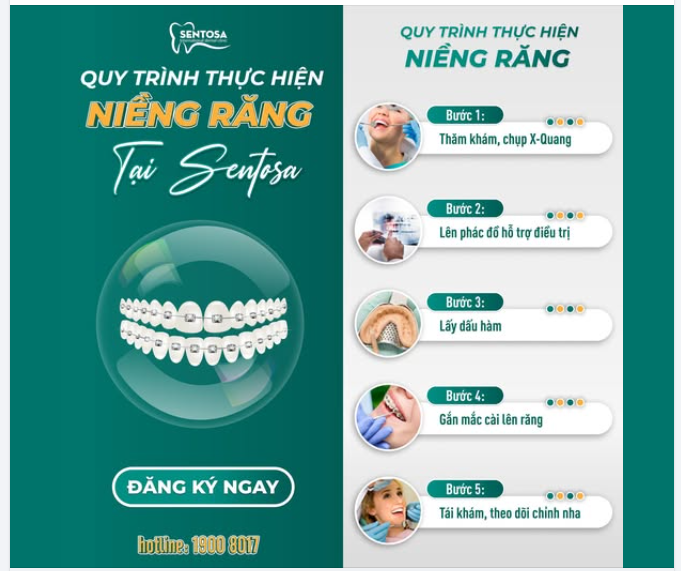 QUY TRÌNH NIỀNG RĂNG MẮC CÀI CÓ THẬT SỰ PHỨC TẠP