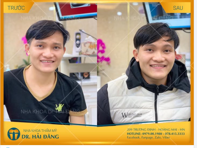 HÀN RĂNG CỬA THẨM MỸ – TỰ TIN CƯỜI TƯƠI RẠNG RỠ